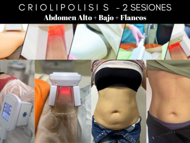 Criolipolisis-1083-x-710-px